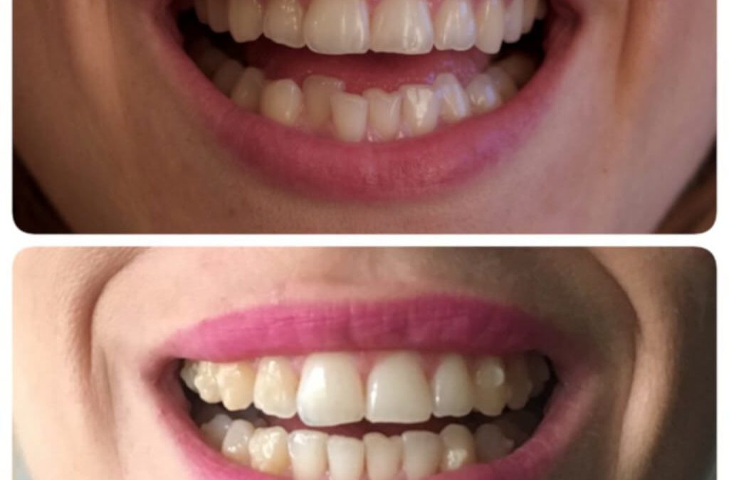 Ataches de invisalign ¿Qué son y para qué sirven