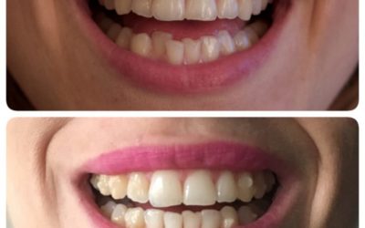 Ataches de invisalign ¿Qué son y para qué sirven