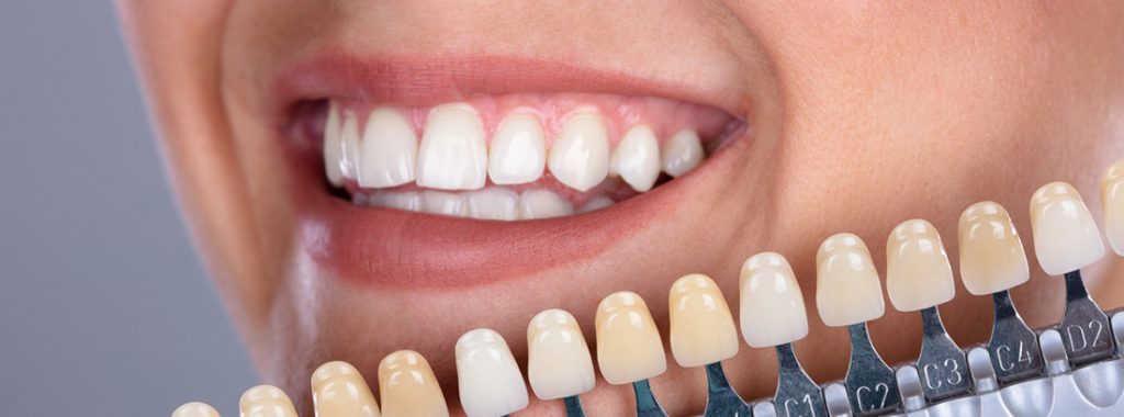 carillas dentales vs ortodoncia