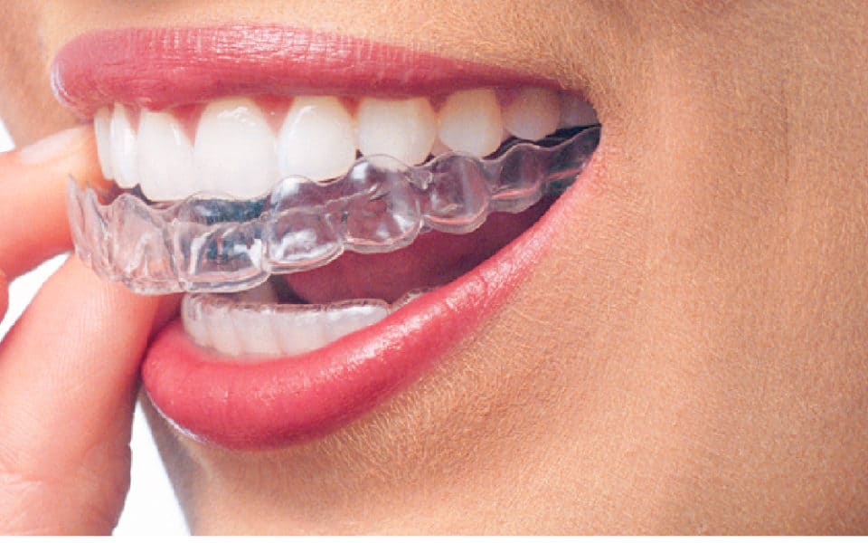 carillas dentales vs ortodoncia