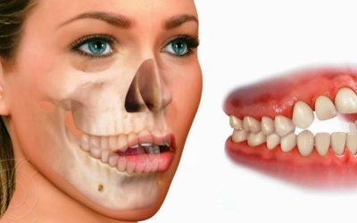 Causas y tratamiento para la mordida cruzada