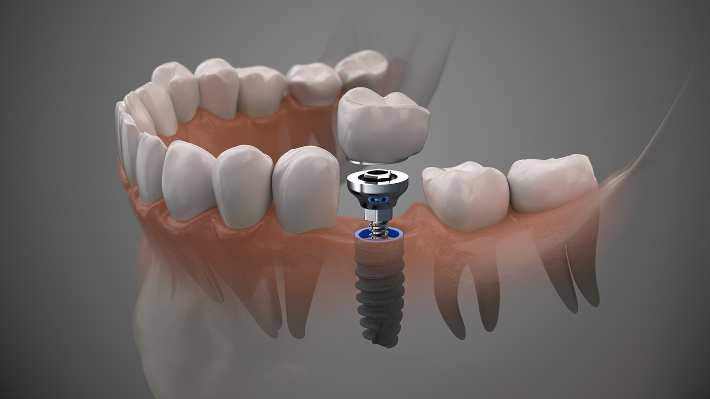colocacion-implante-dental