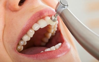 ¿Cuánto cuesta una limpieza dental profesional?