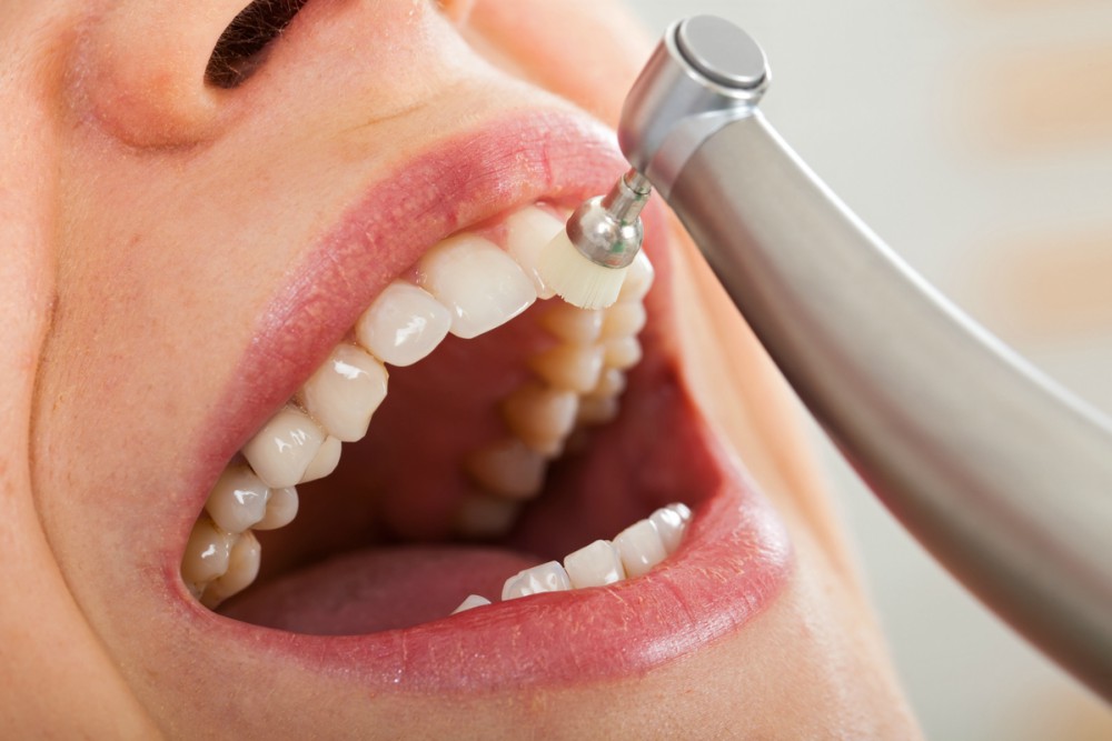 cuanto cuesta una limpieza dental profesional