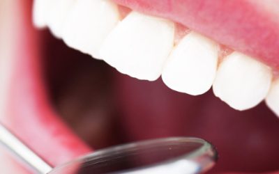 ¿Cuánto tiempo tarda en hacerse un implante dental?