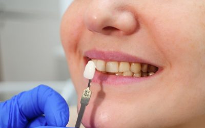 Cuidados y mantenimiento de carillas dentales