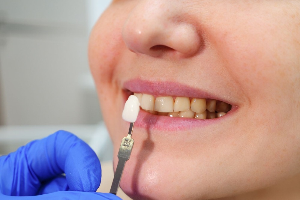 cuidados y mantenimiento de carillas dentales 2