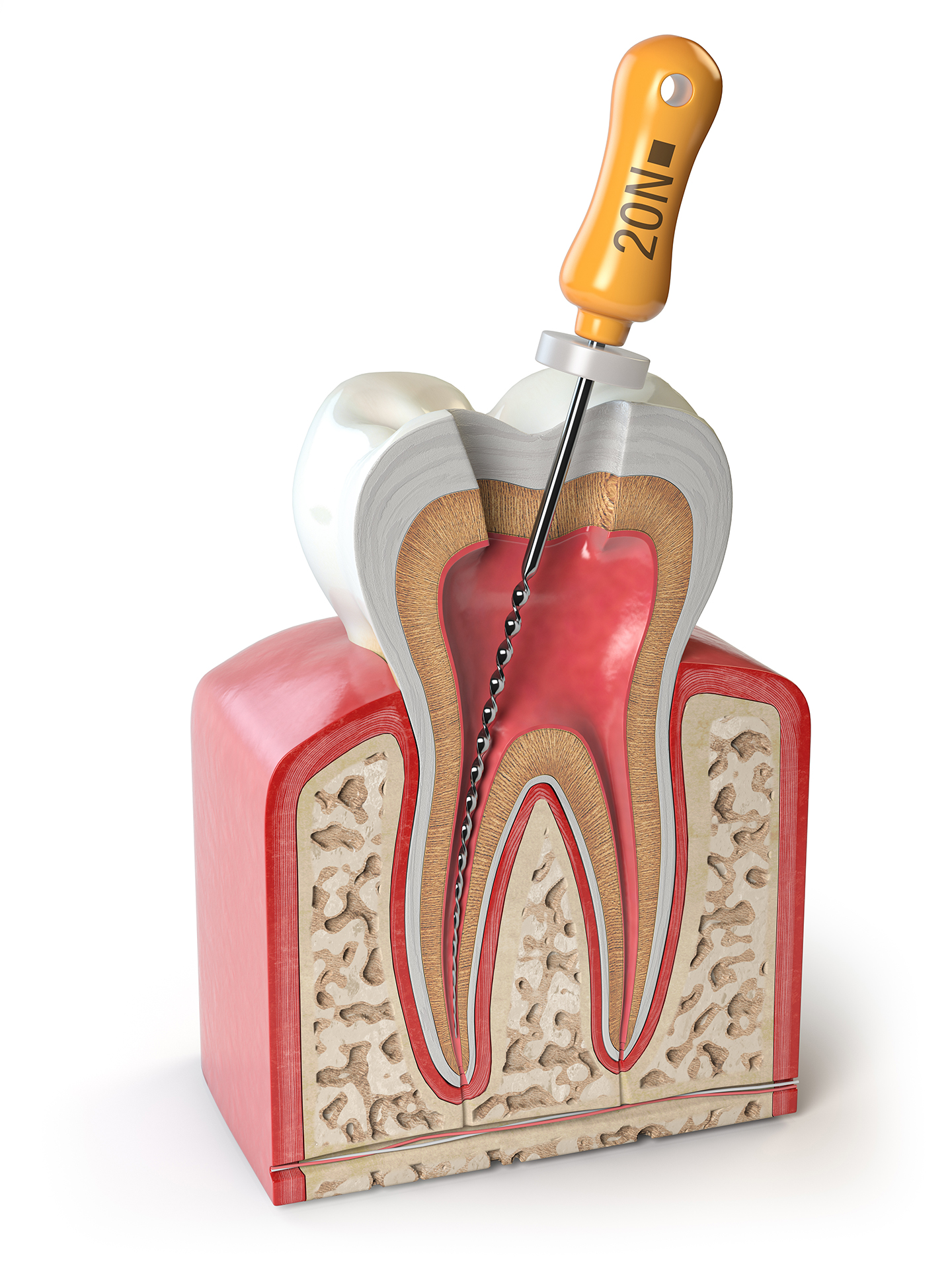 dolor-raiz-diente-endodoncia
