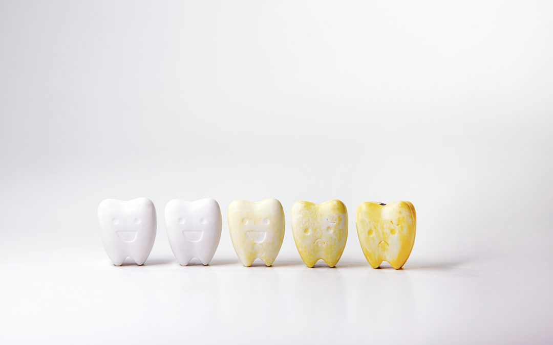 Cómo saber si tengo fluorosis dental