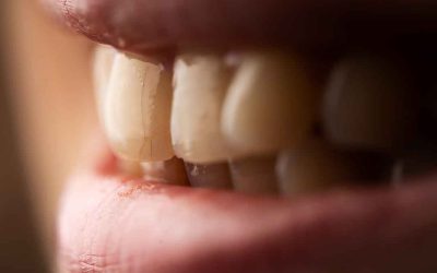 Pequeñas fracturas dentales por desgaste: Causas y tratamientos