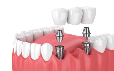 ¿Cuál es el proceso para poner un implante dental?