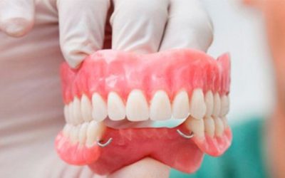 Implantes o puentes dentales: ¿qué es mejor para mí?