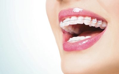 ¿Carillas dentales o Brackets?