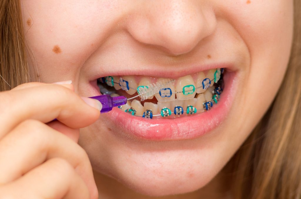 Cómo saber si tu hijo necesita ortodoncia