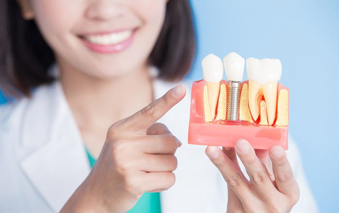 proceso implantes dentales