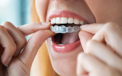 ¿Cómo es el proceso de un tratamiento con Invisalign?