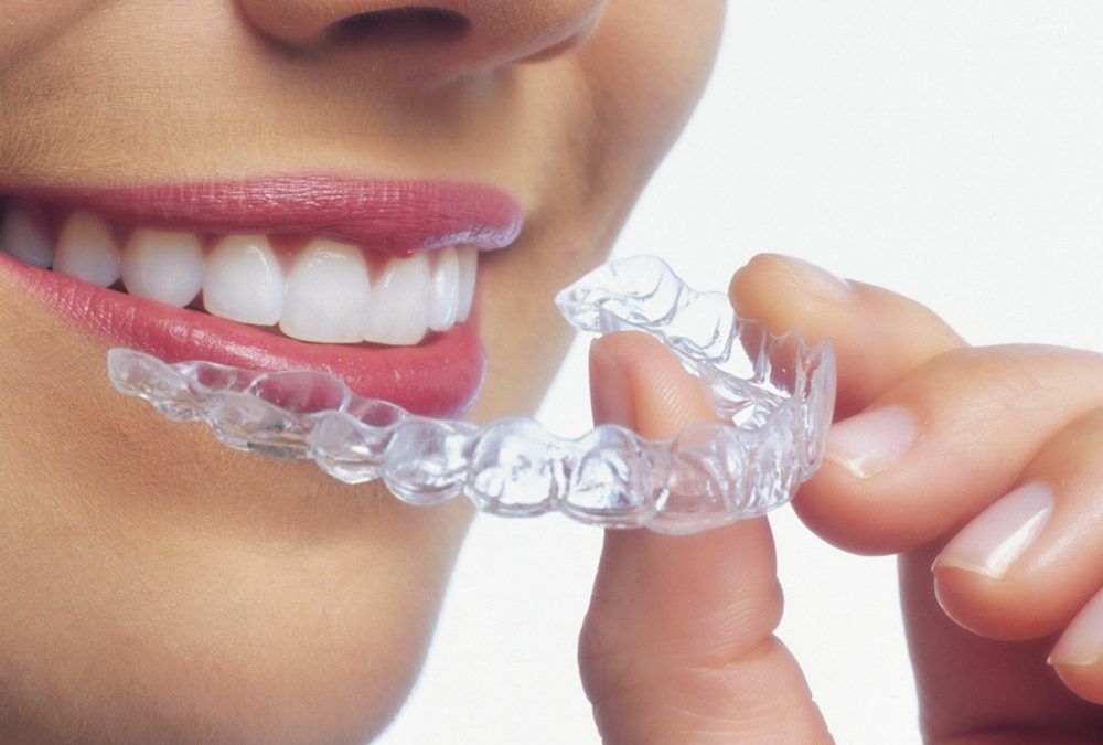 Ventajas de la ortodoncia Invisalign