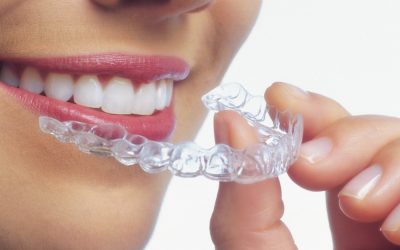 Ventajas de la ortodoncia Invisalign
